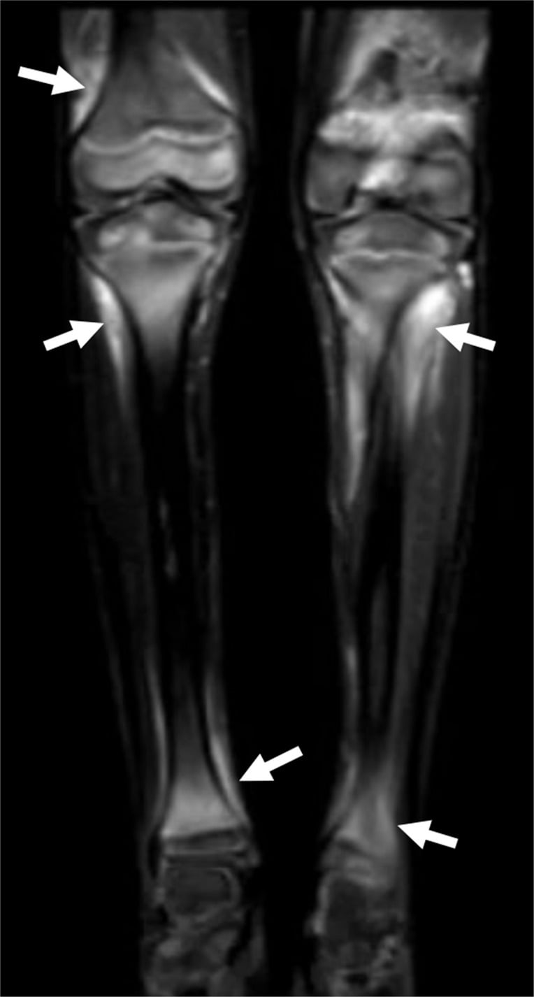 Coronal MRI of both lower legs with arrows at high metaphyseal and periosteal signal in scurvy