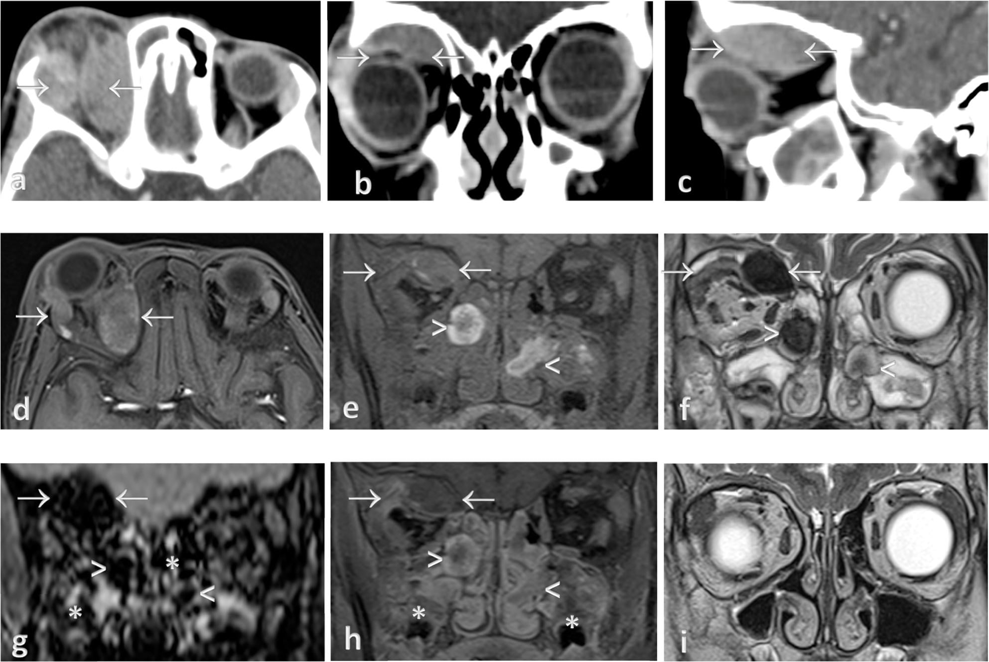 Orbital CT (a-c) and MRI (d-i) with arrows marking a superior subperiosteal haematoma in the right orbit in paediatric scurvy