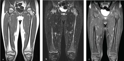 Three coronal MRI panels of both thighs showing normalised femoral marrow after vitamin C treatment