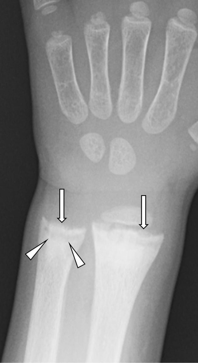 Wrist radiograph showing metaphyseal cupping and fraying from rickets