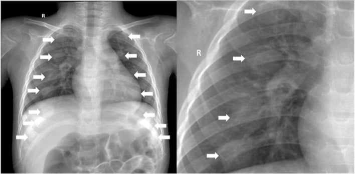 AP chest radiograph demonstrating costochondral junction expansion in scorbutic rosary