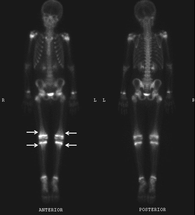 Whole-body bone scan, anterior and posterior views, with symmetric periarticular uptake and arrows at both knees in paediatric scurvy