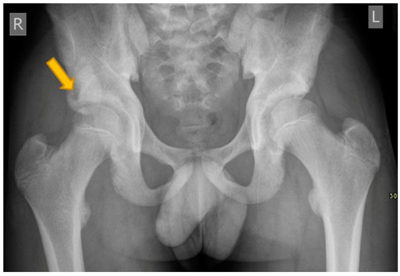 AP pelvis radiograph showing an acute anterior inferior iliac spine avulsion fracture in an adolescent.