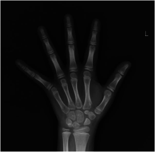 Left hand and wrist radiograph used to document delayed bone age in severe hypothyroidism.