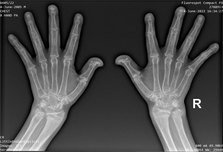 Bilateral hand radiographs showing osteopenia and terminal tuft changes in severe hyperparathyroid bone disease.