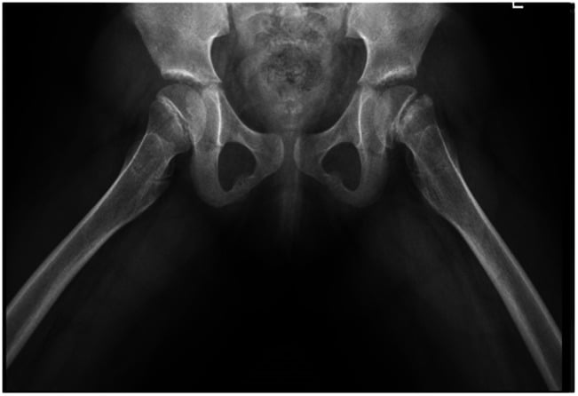 Pelvis radiograph showing slipped upper femoral epiphysis in a child with severe primary hypothyroidism.