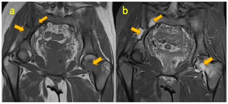 Coronal pelvis MRI showing multifocal osteolytic lesions from Langerhans cell histiocytosis.