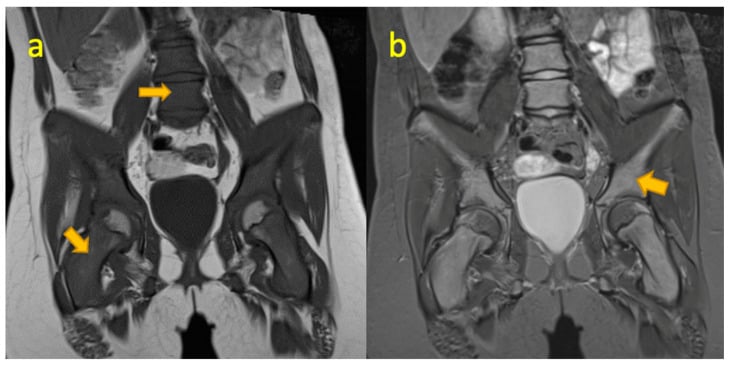 Coronal T1 and STIR pelvis MRI showing diffuse marrow infiltration from acute lymphoblastic leukaemia.