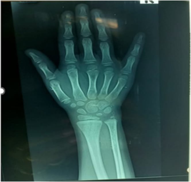 Hand and wrist radiograph showing skeletal age of about seven years at a chronological age of twelve years.