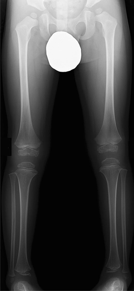 Pelvis and knee radiographs showing delayed disorganised epiphyseal ossification in multiple epiphyseal dysplasia.