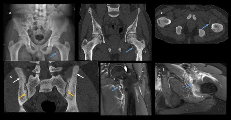 Pelvic radiograph, CT and MRI showing renal osteodystrophy with avulsion injury, sclerosis and subperiosteal resorption.