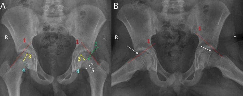 AP and frog-lateral pelvis radiographs annotated with the principal signs of slipped upper femoral epiphysis.