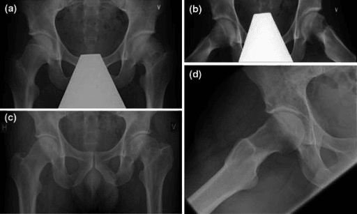 Paired AP and frog-leg lateral hip radiographs of a 17-year-old male following treatment of a left slipped capital femoral epiphysis.