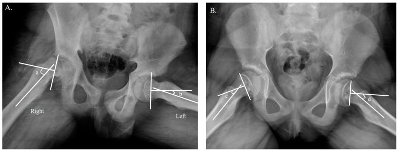 Frog-lateral radiographs demonstrating Southwick angle measurement in unilateral and bilateral slipped upper femoral epiphysis.