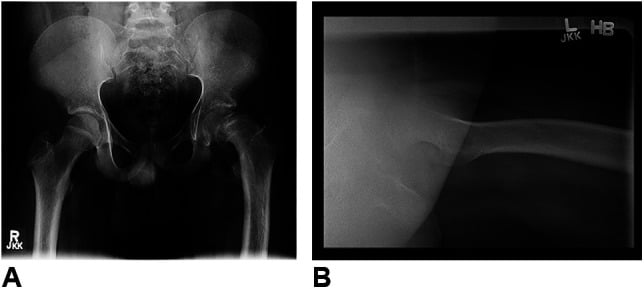 AP pelvis and lateral hip radiographs showing a unilateral left slipped upper femoral epiphysis.