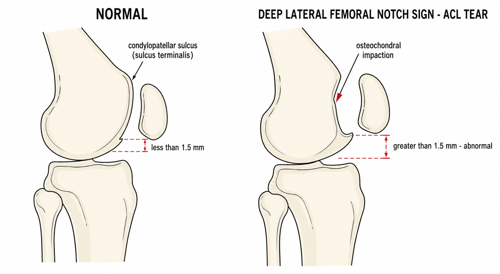 Labelled lateral knee schematic comparing a normal shallow condylopatellar sulcus against a deep lateral femoral notch sign from osteochondral impaction in ACL rupture