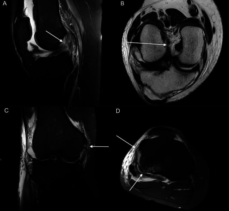 Multiplanar MRI showing complete ACL rupture, partial MCL injury and anterolateral capsular avulsion with posterolateral tibial impaction
