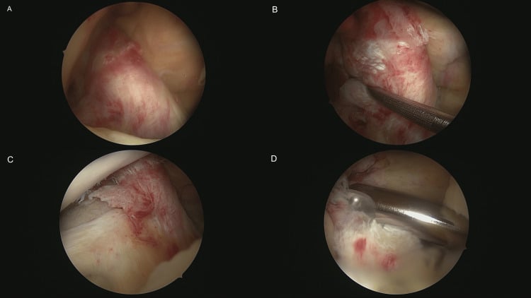 Arthroscopic views confirming complete anterior cruciate ligament rupture in a knee with a Segond fracture