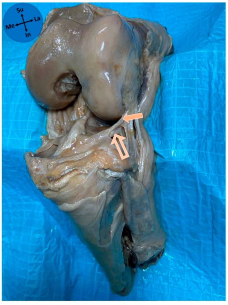 Cadaveric lateral knee dissection showing the anterolateral ligament attached to the superior lateral meniscal margin