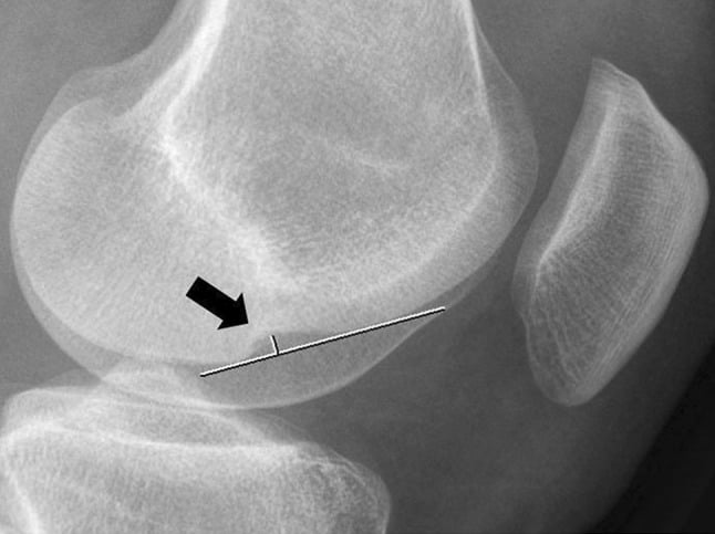 True lateral knee radiograph showing measurement of a deep lateral femoral notch sign
