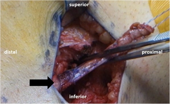 Operative view of an iliotibial-band strip passed deep to the lateral collateral ligament during modified Lemaire tenodesis