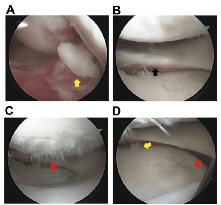 Arthroscopy showing a free cartilage fragment and rapid chondral deterioration after combined Segond, ACL and lateral meniscal surgery