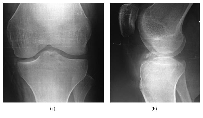 Anteroposterior and lateral radiographs showing a reverse Segond fracture with tibial eminence avulsion
