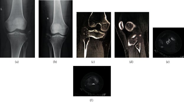 Bilateral knee radiographs and CT showing Segond fractures with fibular-head arcuate avulsions