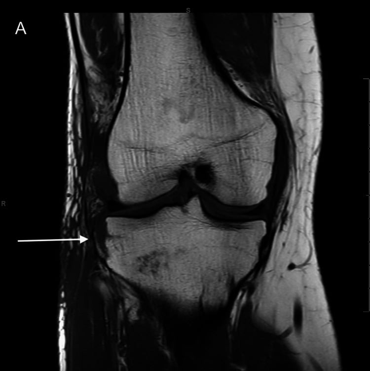 Coronal knee MRI with an arrow at the Segond fragment at the lateral tibial rim