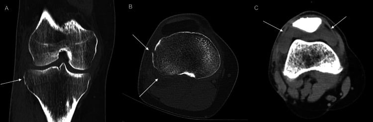 Coronal and axial CT showing a minimally displaced Segond fragment, posterolateral impaction and haemarthrosis