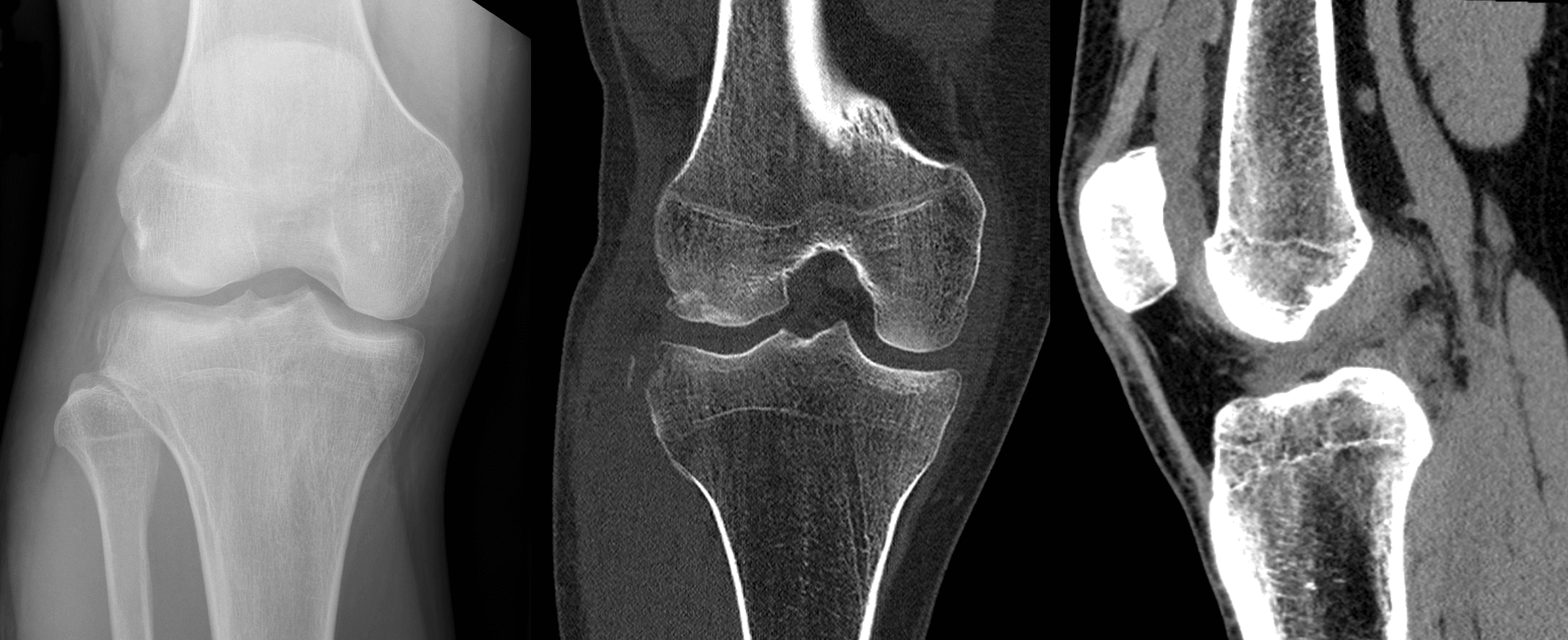 Radiograph and coronal/sagittal CT of a Segond fracture showing the lateral tibial-plateau avulsion fragment.