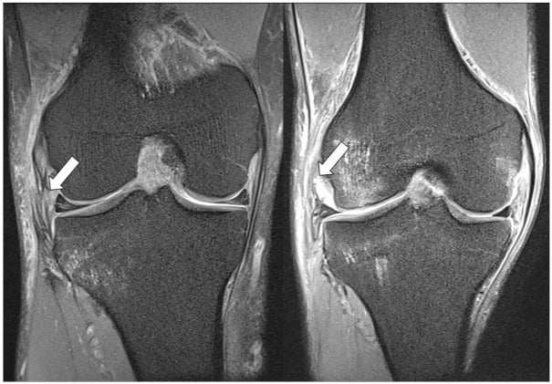 Coronal T2 FS MRI demonstrating Segond avulsion fracture of anterolateral tibial rim and ACL tear