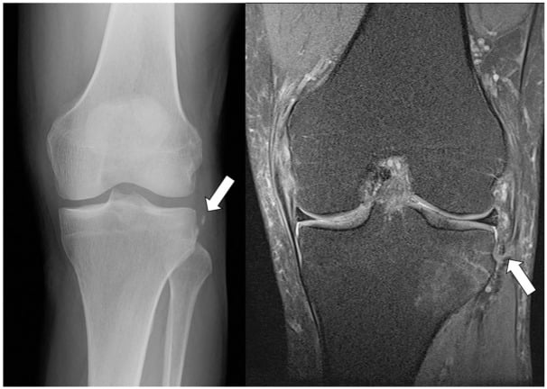 Coronal T2 MRI demonstrating ALL capsule avulsion fracture and bone marrow edema