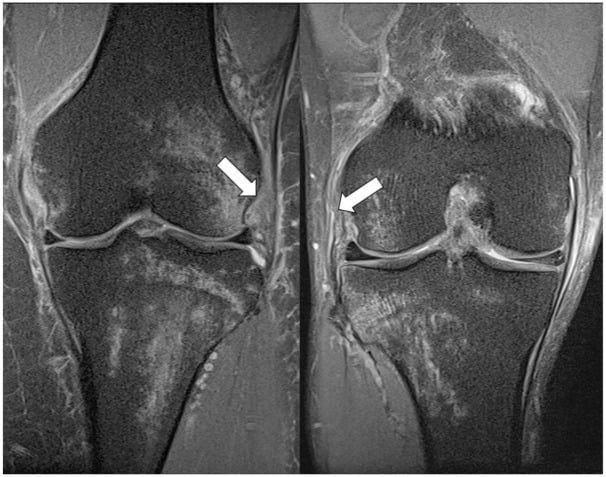 Axial T2 MRI demonstrating deep lateral femoral notch sign and Segond fracture