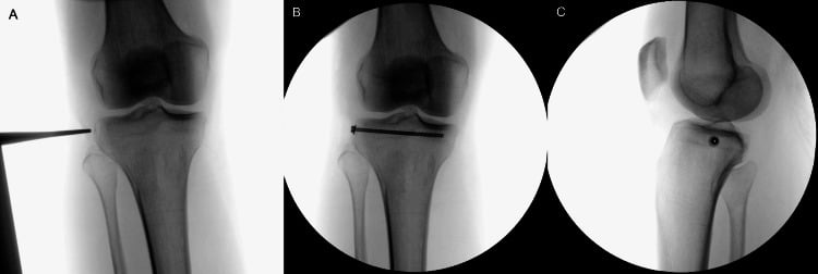 Intraoperative anteroposterior and lateral fluoroscopy before and after screw fixation of a large Segond fragment