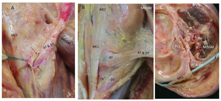 Ultrasound-guided injection and dissection of anterior and direct semimembranosus tendons beneath the MCL