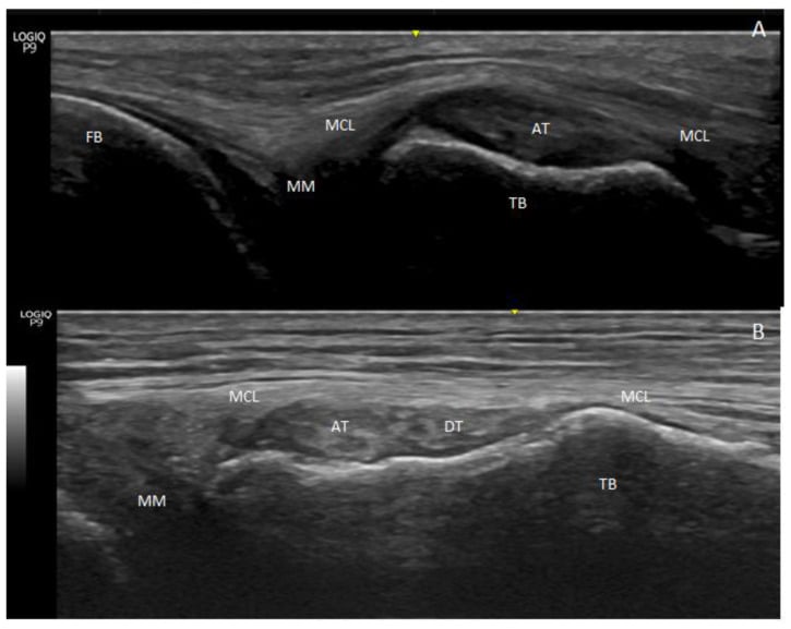 Long-axis and short-axis ultrasound of anterior and direct semimembranosus tendon insertion