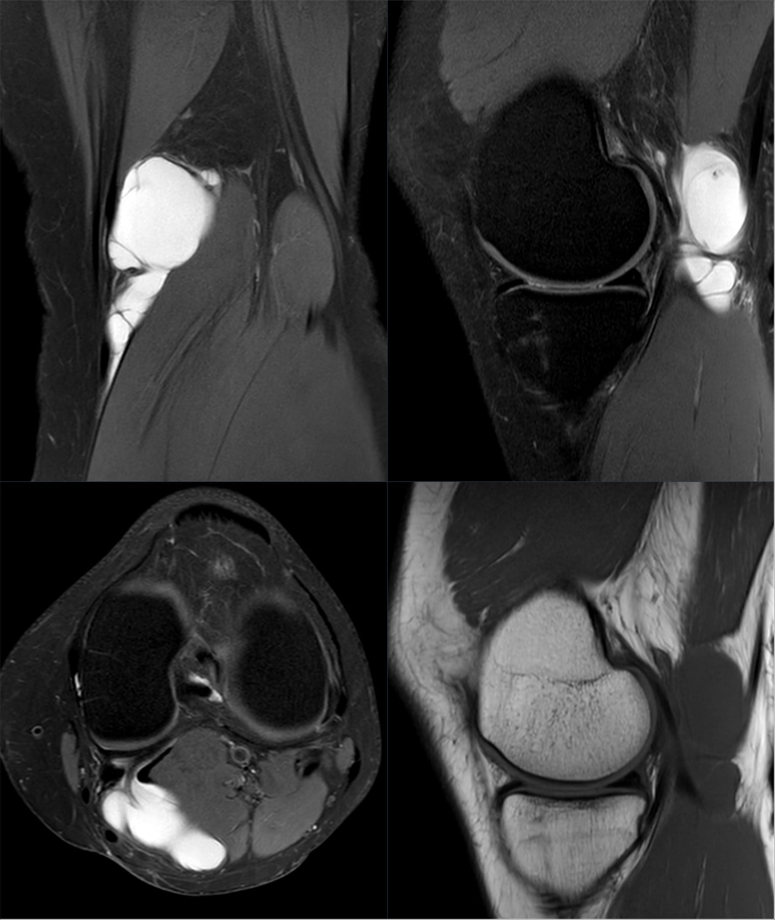 Multiplanar knee MRI of a Baker cyst between semimembranosus and medial gastrocnemius