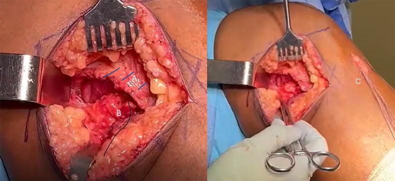 Operative photographs of acute distal semimembranosus tendon repair