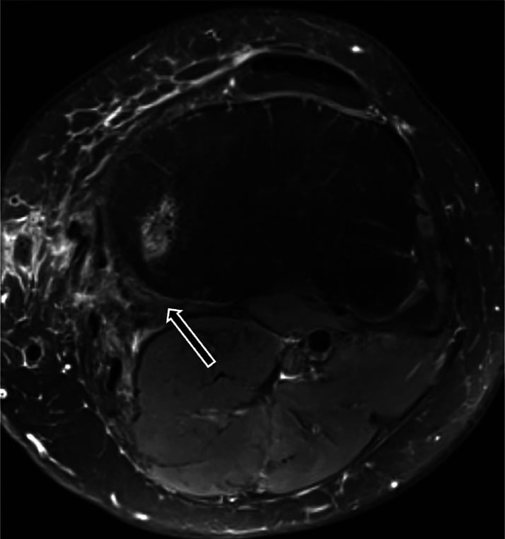 Axial T2 MRI of a healed distal semimembranosus tendon after repair