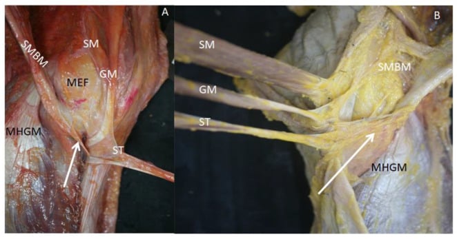 Posterior and medial dissections of pes anserinus and semimembranosus relationships