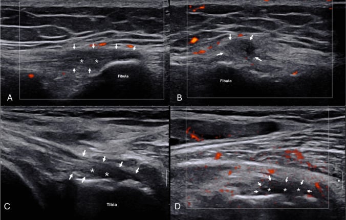 Ultrasound panels showing semimembranosus insertion hypoechogenicity