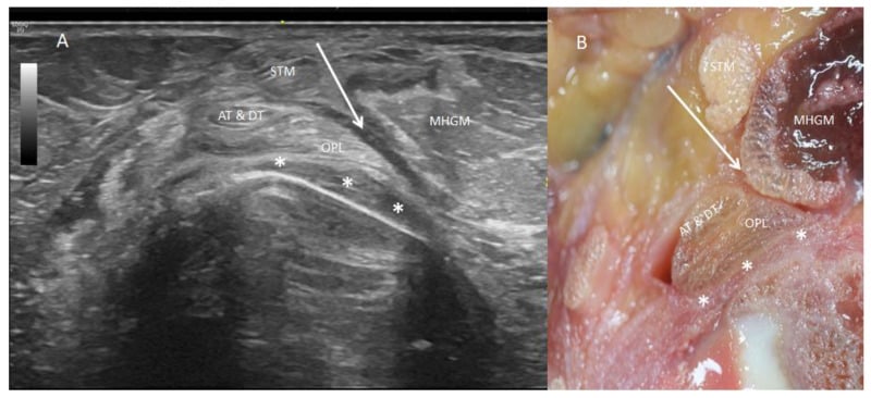 Ultrasound and posterior dissection showing distal semimembranosus tendon division