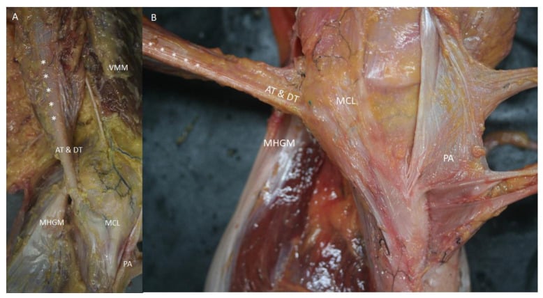 Medial knee dissection showing anterior and direct semimembranosus tendon insertions