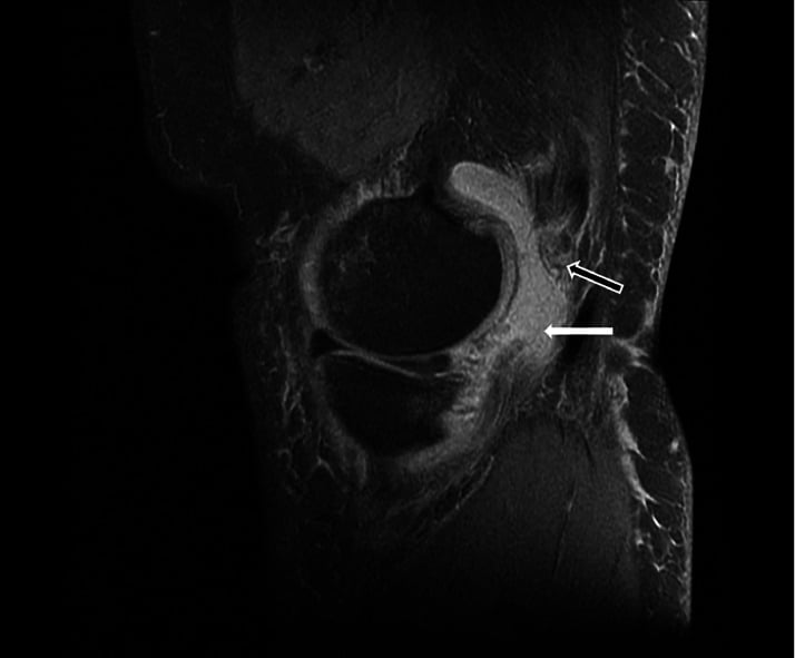 Sagittal T2-weighted MRI of the knee showing the distal semimembranosus tendon at its posteromedial tibial insertion
