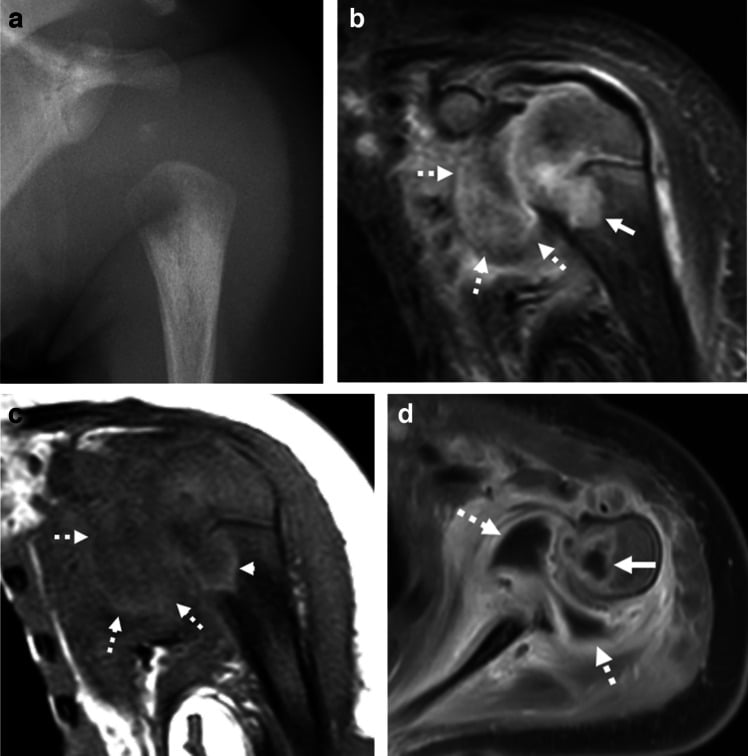Frontal radiograph and coronal T2 MRI demonstrating joint effusion and cartilage destruction