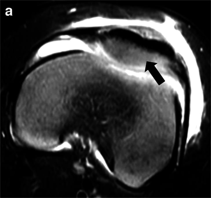 Coronal T2 STIR MRI demonstrating unossified epiphyseal chondritis and cartilage matrix degradation