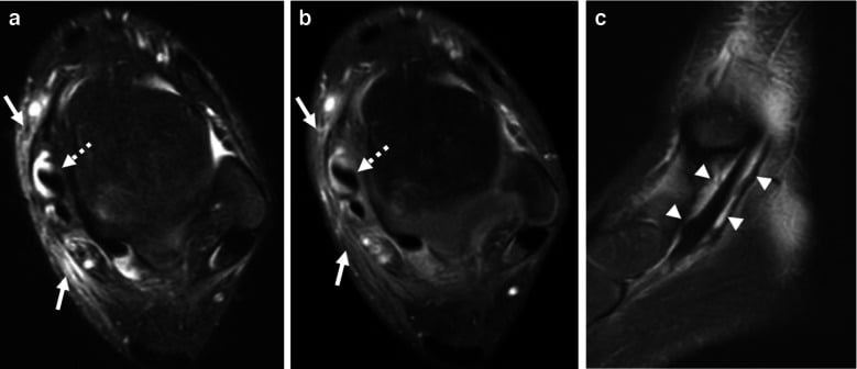 High-resolution ultrasound demonstrating joint fluid distension and capsular bulging