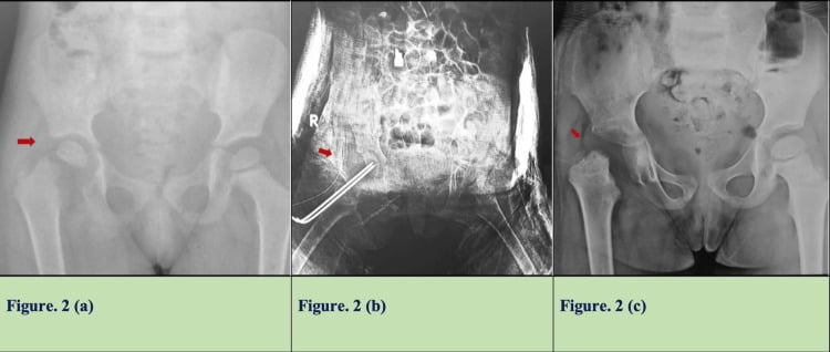 Three radiographs, panels a to c, of a septic right hip with capital slip: at presentation, after K-wire fixation, and at follow-up with complete capital epiphyseal resorption.