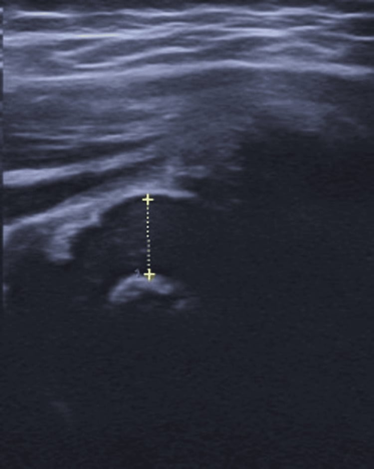 Hip ultrasound with calipers measuring the depth of a joint effusion.